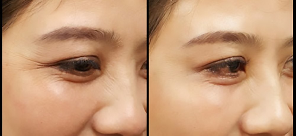 7 tuyệt chiêu trẻ hóa da vùng mắt hiệu quả lại tiết kiệm và an toàn